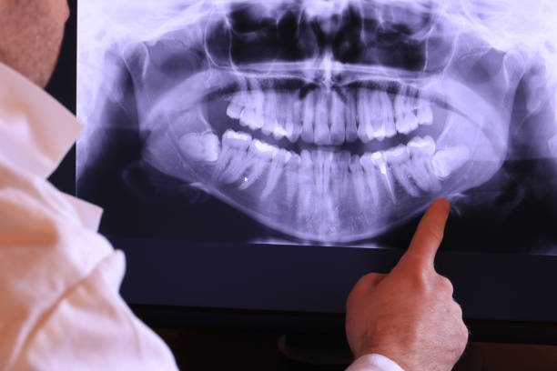 Best Emergency Root Canal Treatment in Milton, WA